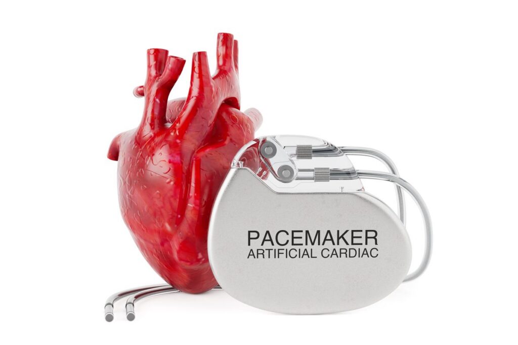 Implantable cardiac pacemaker device used to manage heart rhythm in patients with AFib